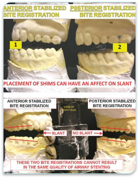 X-Slant Posterior Shim System (pack of 5)