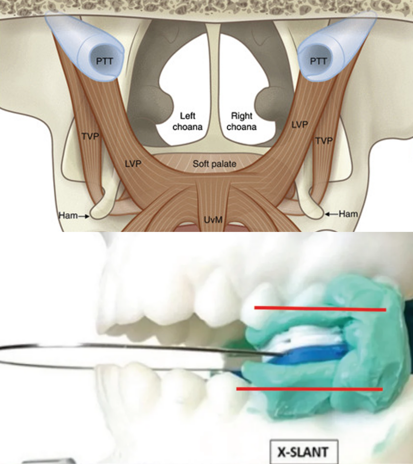 X-Slant Posterior Shim System (pack of 5)